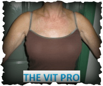 The Vit Pro logo showing repigmentation of vitiligo on torso